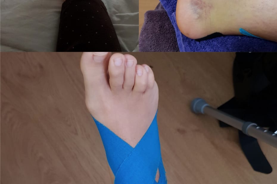 sprained ankle